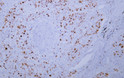 Immunohistochemistry - Paraffin (IHC-P): Human lung squamous cell carcinoma tissue was stained with Anti-Topoisomerase STJA0039030