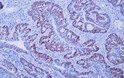 Immunohistochemistry - Paraffin (IHC-P): Human colon carcinoma tissue was stained with Anti-p53 (ABT002) Antibody STJA0039033