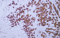 Immunohistochemistry - Paraffin (IHC-P): Human hepatocellular carcinoma tissue was stained with Anti-Cytokeratin STJA0039043
