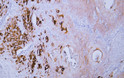 Immunohistochemistry - Paraffin (IHC-P): Human cervical squamous cell carcinoma tissue was stained with STJA0039053