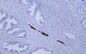 Immunohistochemistry - Paraffin (IHC-P): Human prostatic adenocarcinoma tissue was stained with Anti-Neurofilament STJA0039056
