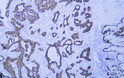Immunohistochemistry - Paraffin (IHC-P): Human lung adenocarcinoma tissue was stained with Anti-Cytokeratin 8 (ABT538) STJA0039057