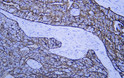 Immunohistochemistry - Paraffin (IHC-P): Human gastric adenocarcinoma tissue was stained with Anti-Cytokeratin 8 STJA0039058