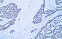Immunohistochemistry - Paraffin (IHC-P): Human lung adenocarcinoma tissue was stained with Anti-Cytokeratin 8 (ABT536) STJA0039058
