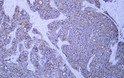 Immunohistochemistry - Paraffin (IHC-P): Human gastric adenocarcinoma tissue was stained with Anti-Cytokeratin 8 STJA0039059