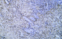 Immunohistochemistry - Paraffin (IHC-P): Human hepatocellular carcinoma tissue was stained with Anti-Cytokeratin 8 STJA0039060