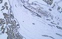 Immunohistochemistry - Paraffin (IHC-P): Human thyroid follicular carcinoma tissue was stained with Anti-Cytokeratin 8 STJA0039060