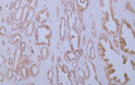 Immunohistochemistry - Paraffin (IHC-P): Human prostatic adenocarcinoma tissue was stained with Anti-p120 Catenin STJA0039069