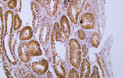 Immunohistochemistry - Paraffin (IHC-P): Human endometrial adenocarcinoma tissue was stained with Anti-Vimentin STJA0039073