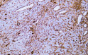 Immunohistochemistry - Paraffin (IHC-P): Human hepatocellular carcinoma tissue was stained with Anti-Vimentin (ABT281) STJA0039073