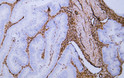 Immunohistochemistry - Paraffin (IHC-P): Human rectal carcinoma tissue was stained with Anti-Vimentin (ABT281) Antibody. STJA0039073