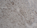 Immunohistochemical analysis of paraffin-embedded hemangioendothelioma. 1, Antibody was diluted at 1:200 (4°C STJA0039088