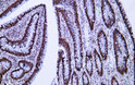 Immunohistochemistry - Paraffin (IHC-P): Human colon carcinoma tissue was stained with Anti-Nucleophosmin (ABT486) STJA0039122