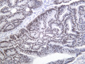 Human colon carcinoma was stained with anti-MSH2 (ABT022) mouse antibody. STJA0040009
