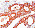 Human HSP60 antibody IHC staining in paraffin-embedded colon cancer tissue with DAB detection