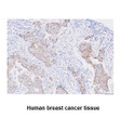 Human STEAP1 antibody IHC staining in breast cancer and prostate hyperplasia tissue sections