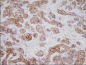 Human gastric cancer tissue immunohistochemistry stained with anti-TPD52L1 antibody using DAB detection