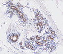 Immunohistochemistry of human Wnt-3a antibody in breast cancer tissue with DAB detection