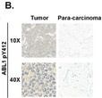 ABL1p-Y412 antibody IHC staining in human breast cancer tissue tumor and para-carcinoma STJA0041064