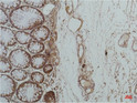 GRP78/Bip antibody immunohistochemistry human colon carcinoma STJA0032966