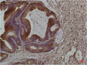 Smad3 antibody immunohistochemistry human colon carcinoma STJA0032967
