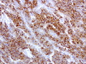 HE4 antibody immunohistochemistry human lung cancer STJA0033308