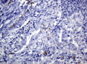 CD1C antibody immunohistochemistry human endometrium adenocarcinoma STJA0033321