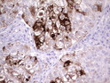 MMP7 antibody immunohistochemistry human lung carcinoma STJA0033339