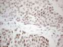 GATA3 antibody immunohistochemistry human urothelial carcinoma STJA0033385