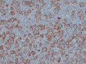 Integrin beta 3 antibody immunohistochemistry giant cell tumor bone STJA0033415