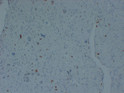 p57 Kip2 antibody immunohistochemistry partial hydatidiform mole STJA0033473