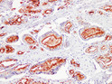 Prostate Specific Antigen antibody immunohistochemistry prostatic carcinoma STJA0033476