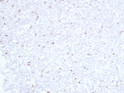 CD3e antibody immunohistochemistry Diffuse large B cell Lymphoma STJA0033503