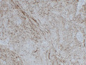GFAP antibody immunohistochemistry Schwannoma paraffin-embedded STJA0033521