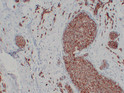 ErbB 2 antibody immunohistochemistry breast carcinoma STJA0033525