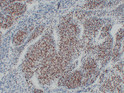 Myoblast Determination Protein 1 antibody immunohistochemistry Rhabdomyosarcoma STJA0033529