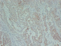TGF beta Receptor II antibody immunohistochemistry colon carcinoma STJA0033543
