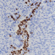 CD15/SSEA1 antibody immunohistochemistry human cervical carcinoma STJA0033695