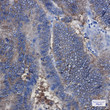 EpCAM antibody immunohistochemistry human colon cancer STJA0034284