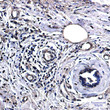 Lactate Dehydrogenase antibody immunohistochemistry human breast cancer STJA0034513
