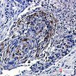 Phospho-mTOR Ser2448 antibody immunohistochemistry human lung cancer STJA0034589