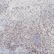 Myoblast Determination Protein 1 antibody immunohistochemistry Embryonal Rhabdomyosarcoma STJA0037666
