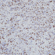 Myogenin antibody immunohistochemistry Embryonal Rhabdomyosarcoma STJA0037675