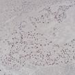 T Box Transcription Factor T antibody immunohistochemistry Chordoma STJA0037715