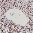 FOXL2 antibody immunohistochemistry ovarian granulosa cell tumor STJA0037726