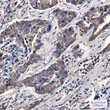 eIF4B Phospho-Ser406 antibody immunohistochemistry human lung cancer STJA0035063