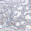 CSDE1/NRU antibody immunohistochemistry human lung cancer tissue STJA0035166