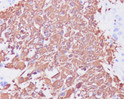 GFAP antibody immunohistochemistry human glioma STJA0035721