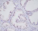 Androgen Receptor antibody immunohistochemistry human prostate carcinoma STJA0035744