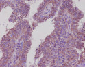 Sodium Potassium ATPase antibody immunohistochemistry human thyroid carcinoma STJA0035808